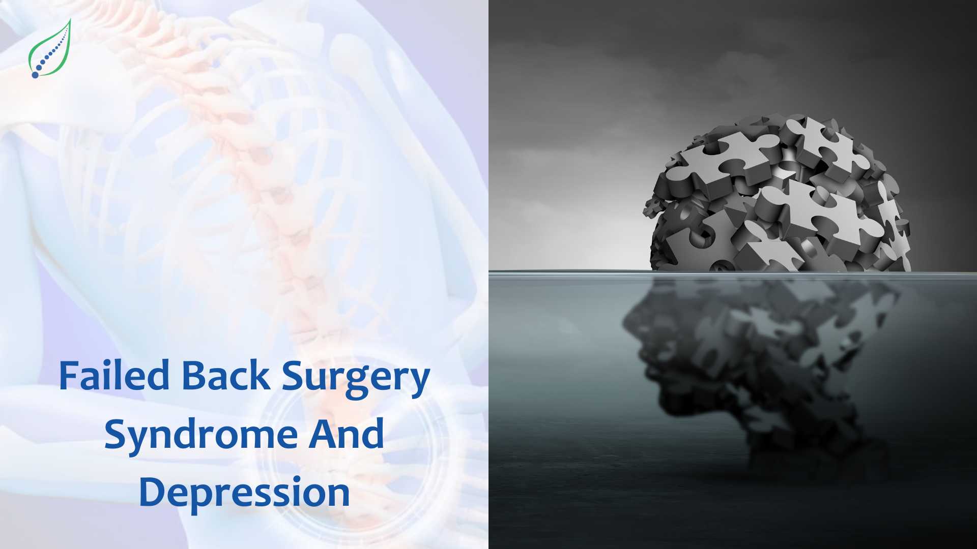 Failed Back Surgery Syndrome And Depression
